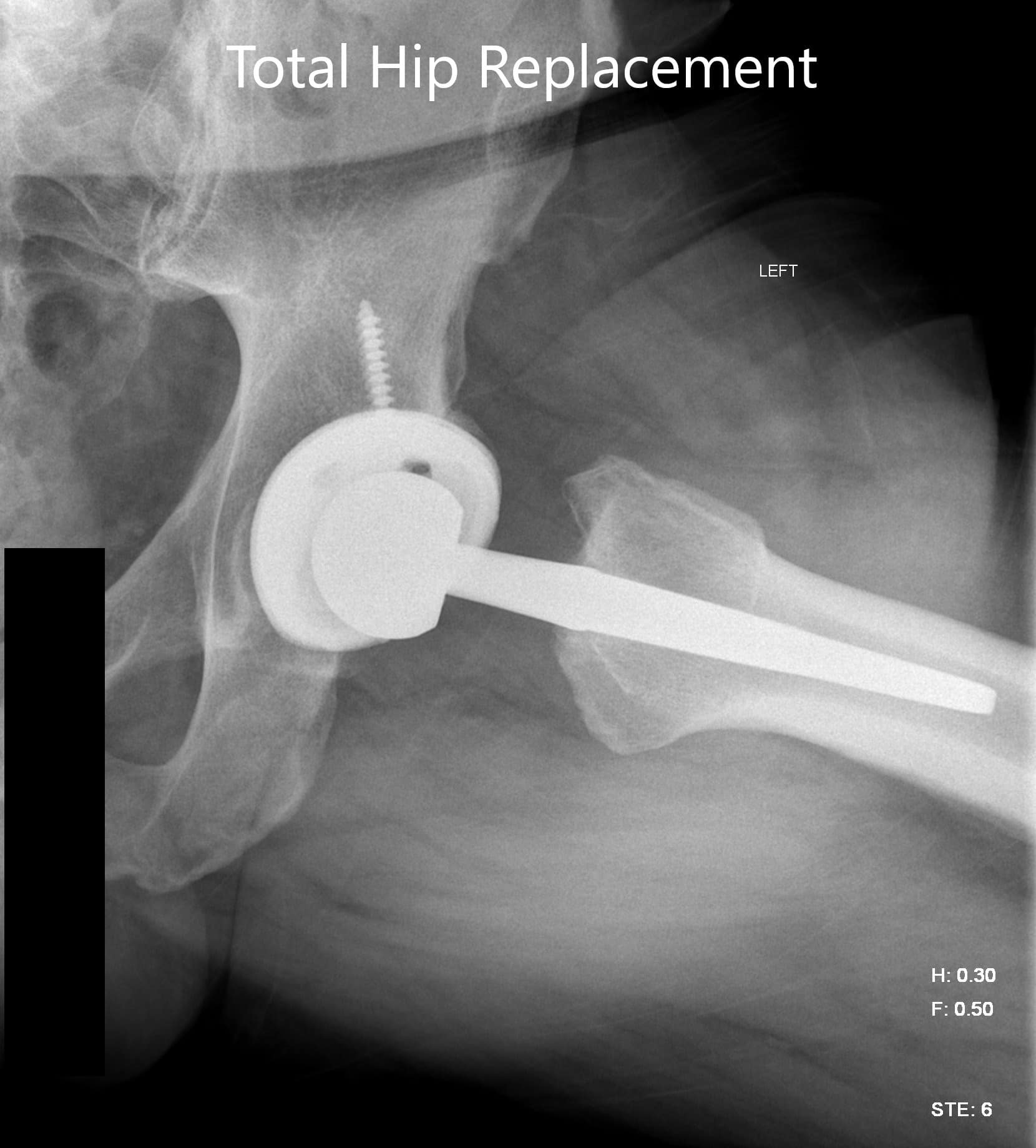 Imágenes de radiografías postoperatorias que muestran la vista AP y la vista lateral con patas de rana - IMG 2