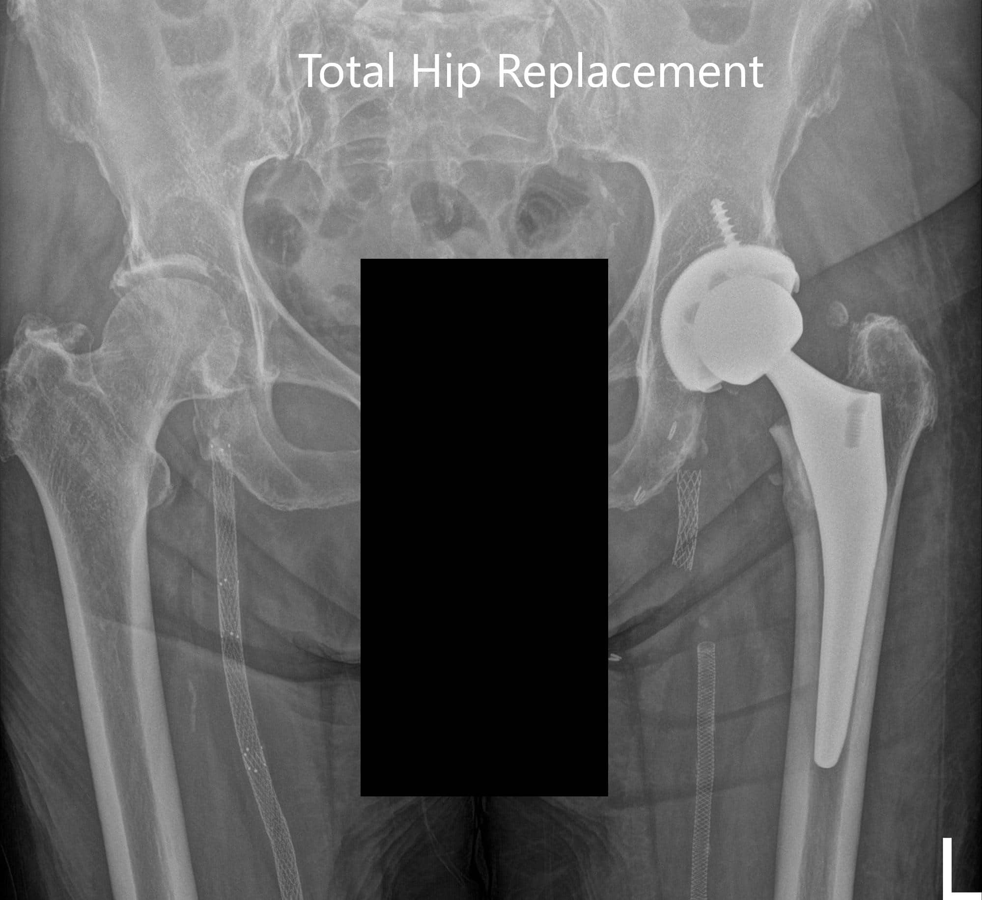 Postoperative X-ray images showing AP and lateral images