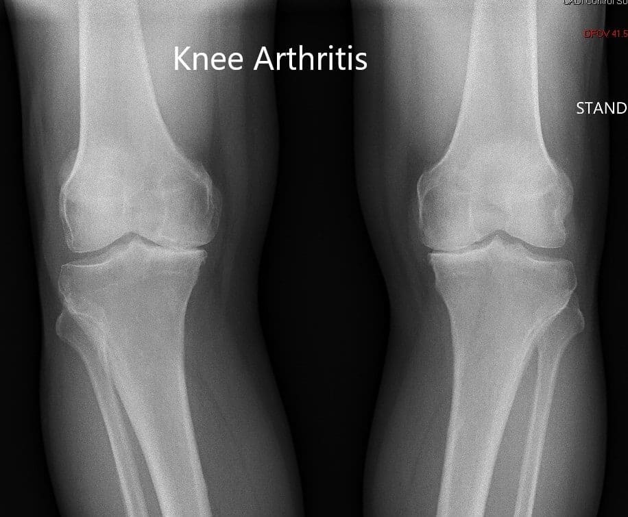 Preoperative X-ray showing the AP view of both the knee joints Preoperative X-ray showing the AP view of both the knee joints
