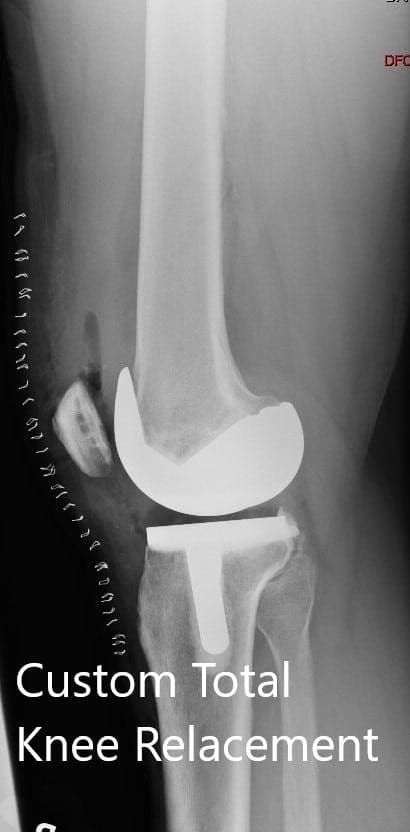 Postoperative X-ray showing the lateral view of the right and the left knee Postoperative X-ray showing the lateral view of the right and the left knee