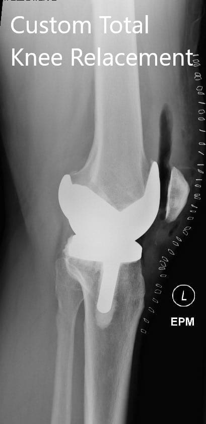 Postoperative X-ray showing the lateral view of the right and the left knee - img 2 Postoperative X-ray showing the lateral view of the right and the left knee - img 2