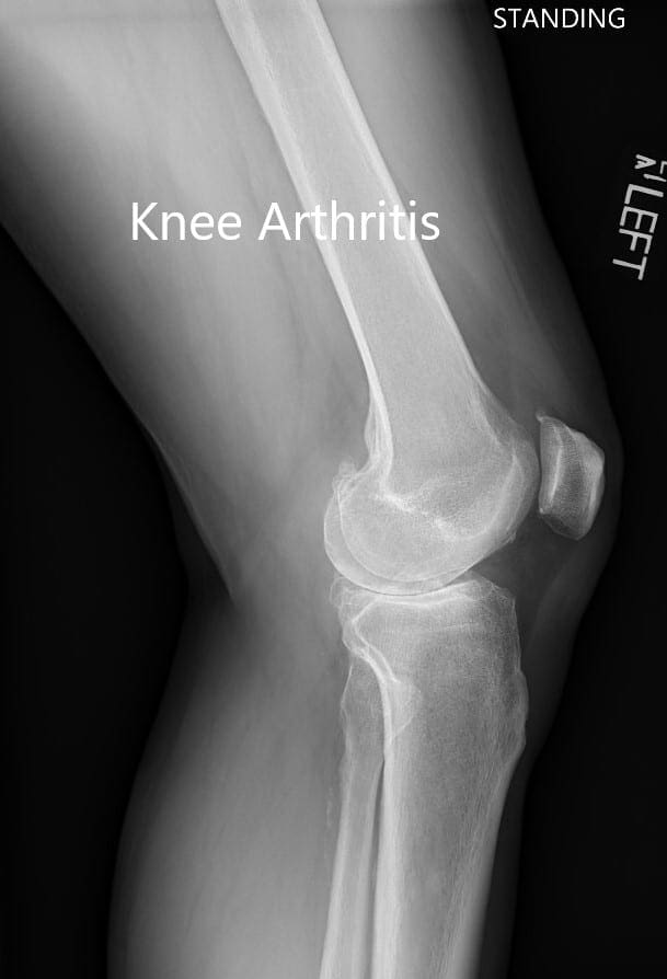 Preoperative X-ray showing the lateral view of the left and the right knee joint Preoperative X-ray showing the lateral view of the left and the right knee joint