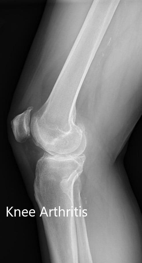 Preoperative X-ray showing the lateral view of the left and the right knee joint- img 2 Preoperative X-ray showing the lateral view of the left and the right knee joint- img 2