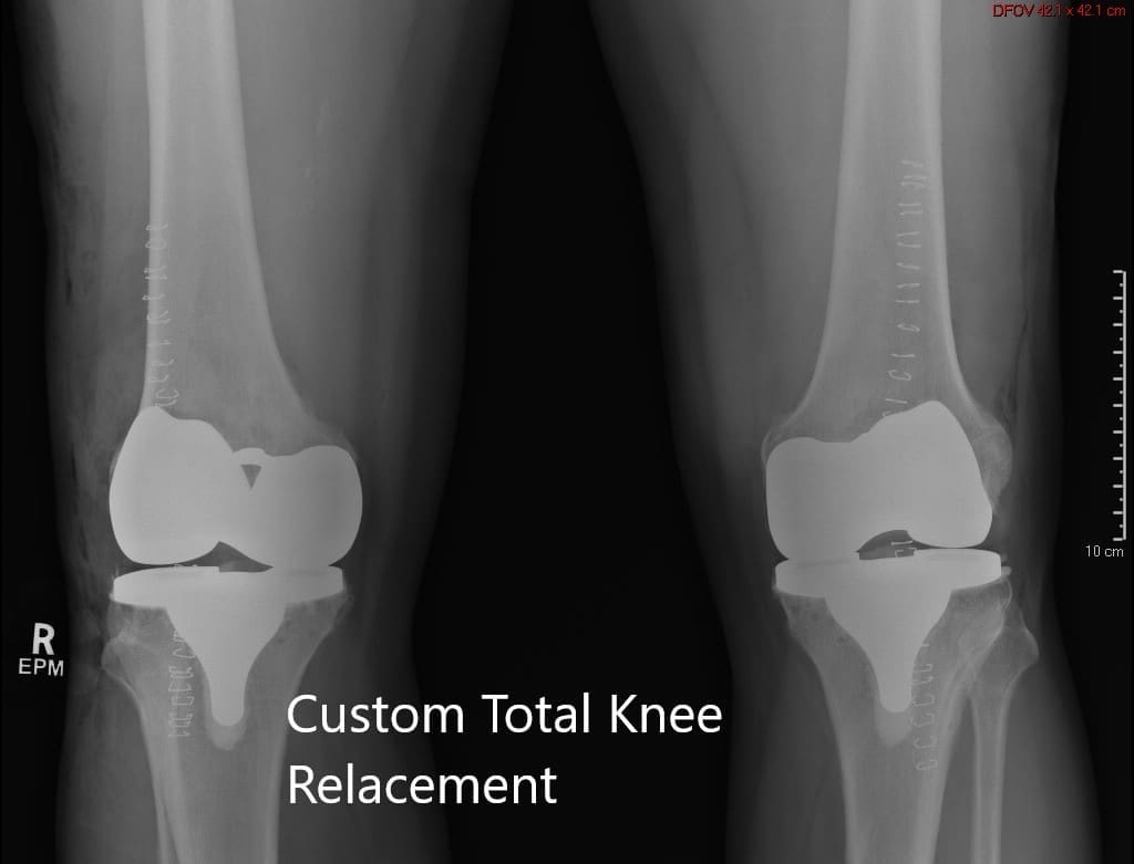 Postoperative X-ray showing the AP view of both knees Postoperative X-ray showing the AP view of both knees