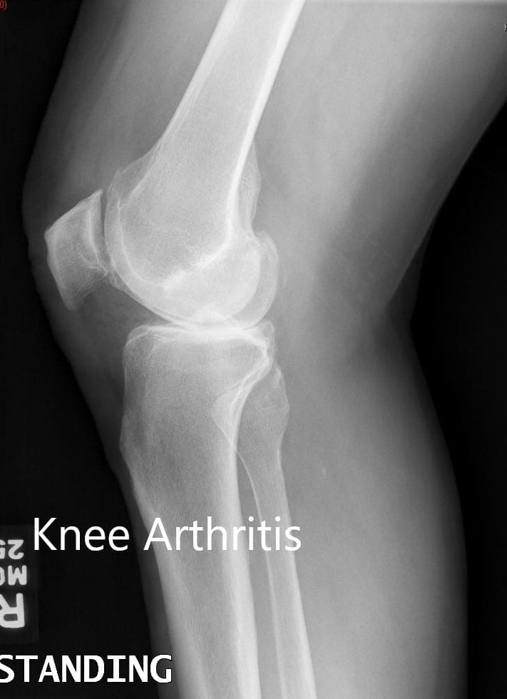 Radiografía preoperatoria que muestra las vistas laterales de la rodilla derecha e izquierda respectivamente