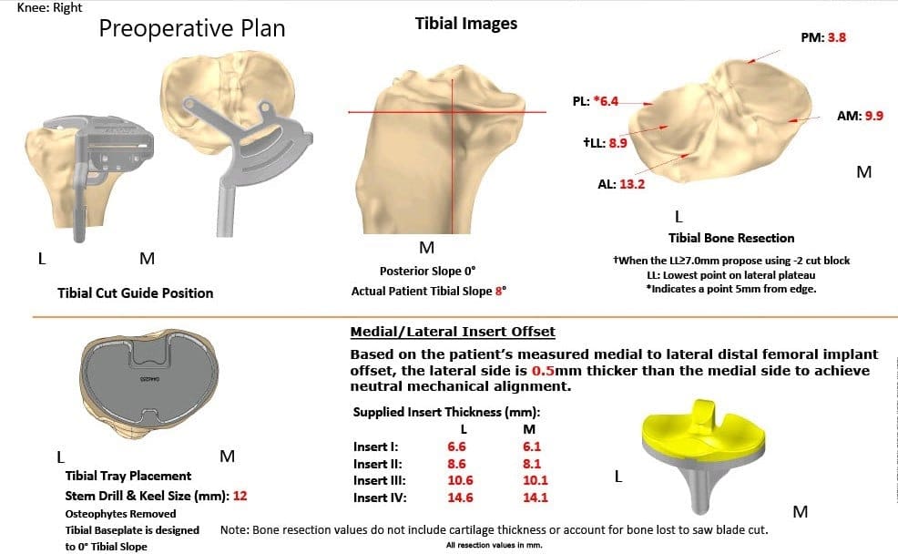 Plan quirúrgico completo específico para pacientes en ortopedia para un reemplazo bilateral personalizado de rodilla total en un paciente de 72 años con artritis