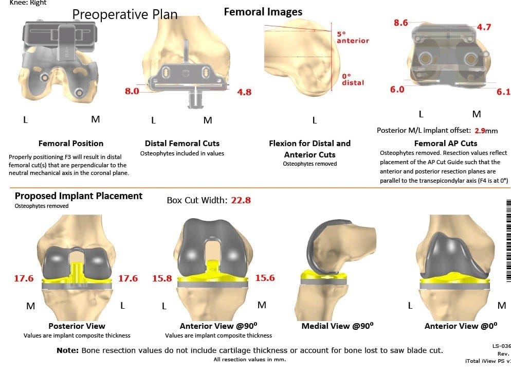 Plan quirúrgico completo específico para paciente en ortopedia para un reemplazo total bilateral personalizado de rodilla en un paciente de 72 años con artritis - ecografía 2