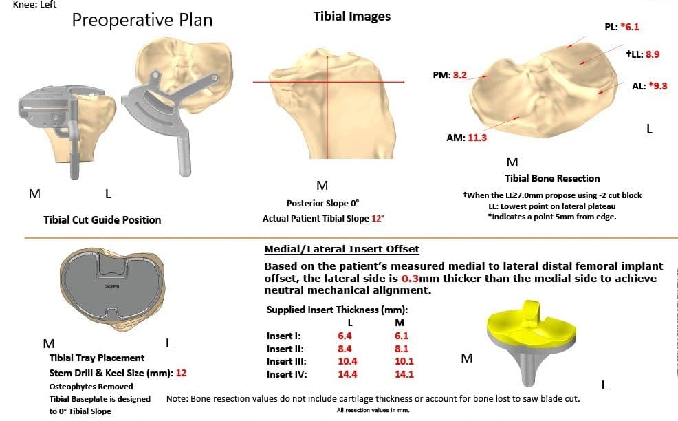 Plan quirúrgico completo específico para pacientes de Ortopedia para un reemplazo total bilateral personalizado de rodilla en un paciente de 72 años con artritis - escaneo 3