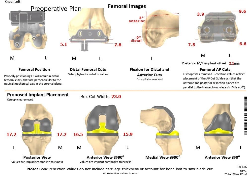 Plan quirúrgico completo específico para pacientes en ortopedia para un reemplazo bilateral personalizado de rodilla total en un paciente de 72 años con artritis - escaneo 4