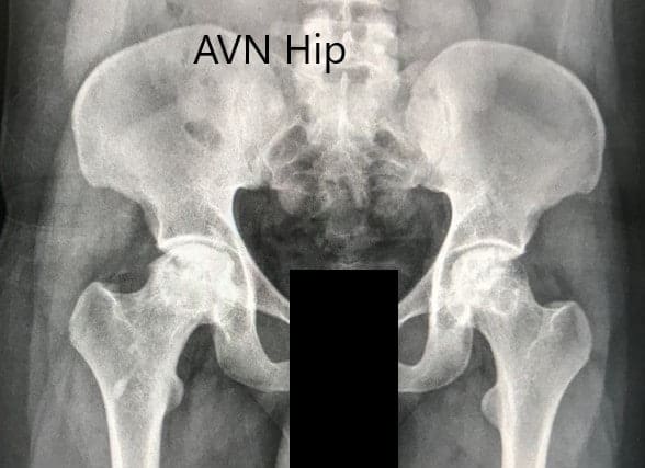 Preoperative X-ray of the pelvis with both hips in anteroposterior view showing AVN of both hips Preoperative X-ray of the pelvis with both hips in anteroposterior view showing AVN of both hips