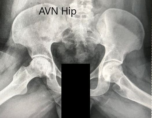 Preoperative X-ray of the pelvis with both hips in the frog-legged lateral view showing AVN of both hips Preoperative X-ray of the pelvis with both hips in the frog-legged lateral view showing AVN of both hips