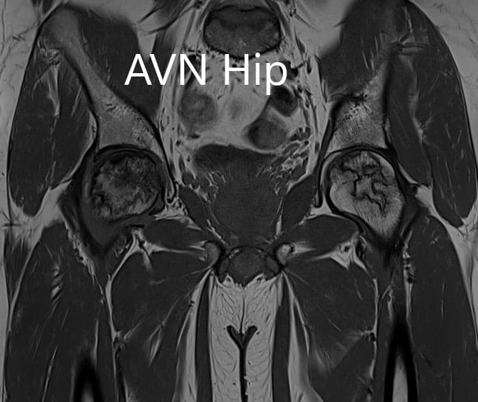 T1WI coronal section of MRI showing AVN hip T1WI coronal section of MRI showing AVN hip
