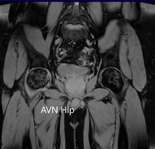 T2WI coronal section of MRI showing AVN hip T2WI coronal section of MRI showing AVN hip