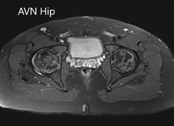 Axial sections of the T1WI of MRI Axial sections of the T1WI of MRI