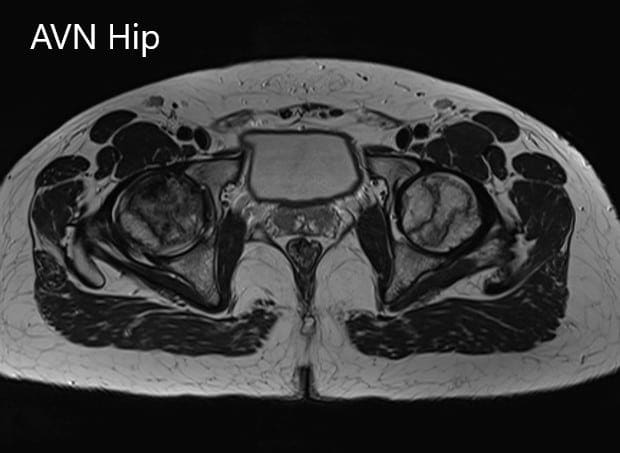 Axial sections of the T2WI of MRI Axial sections of the T2WI of MRI