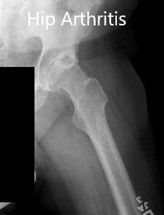 Preoperative X-ray showing the frog-leg lateral views of the right and the left hip joint Preoperative X-ray showing the frog-leg lateral views of the right and the left hip joint