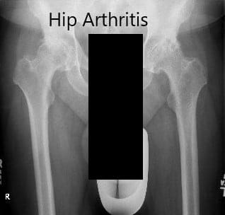 Preoperative X-ray showing the AP view of the pelvis with both the hips Preoperative X-ray showing the AP view of the pelvis with both the hips