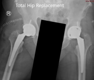 Postoperative X-ray showing the AP view of the pelvis with both hips Postoperative X-ray showing the AP view of the pelvis with both hips