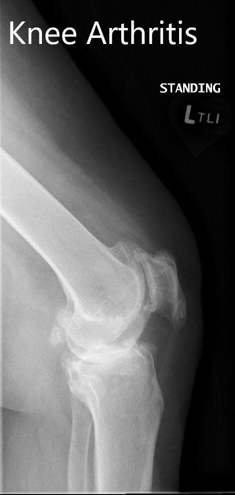Radiografía preoperatoria que muestra las vistas lateral y la vista de la PA Radiografía preoperatoria que muestra las vistas lateral y la vista de la PA
