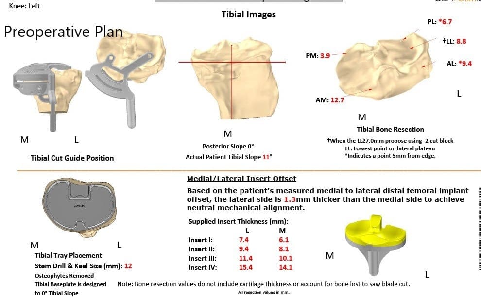 Plan quirúrgico completo específico para pacientes en ortopedia para un reemplazo personalizado de rodilla izquierda en un hombre de 71 años
