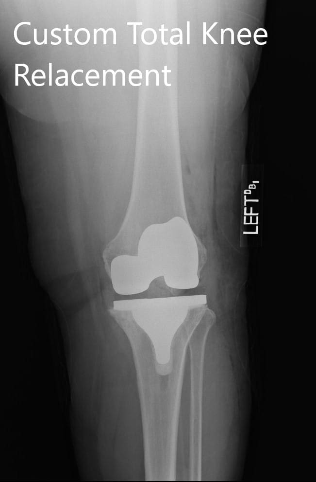 Imágenes de radiografías postoperatorias que muestran la AP y las vistas laterales de la rodilla izquierda Imágenes de radiografías postoperatorias que muestran la AP y las vistas laterales de la rodilla izquierda