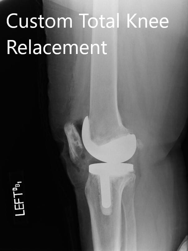 Imágenes postoperatorias de radiografías que muestran la AP y las vistas laterales de la rodilla izquierda - IMG 2 Imágenes postoperatorias de radiografías que muestran la AP y las vistas laterales de la rodilla izquierda - IMG 2