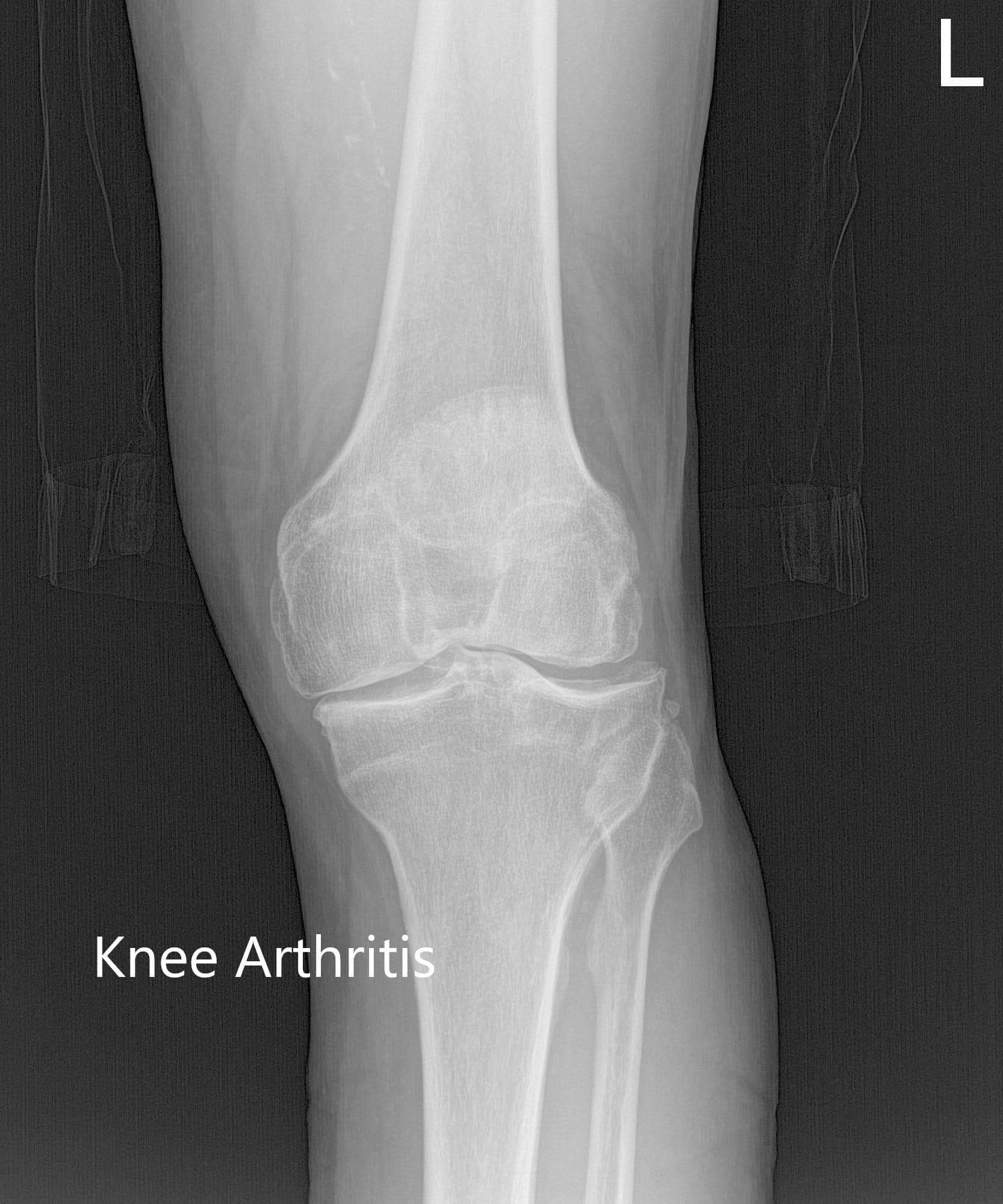 Radiografía preoperatoria de la rodilla izquierda que muestra las vistas AP, lateral y de la izquierda Radiografía preoperatoria de la rodilla izquierda que muestra las vistas AP, lateral y de la izquierda