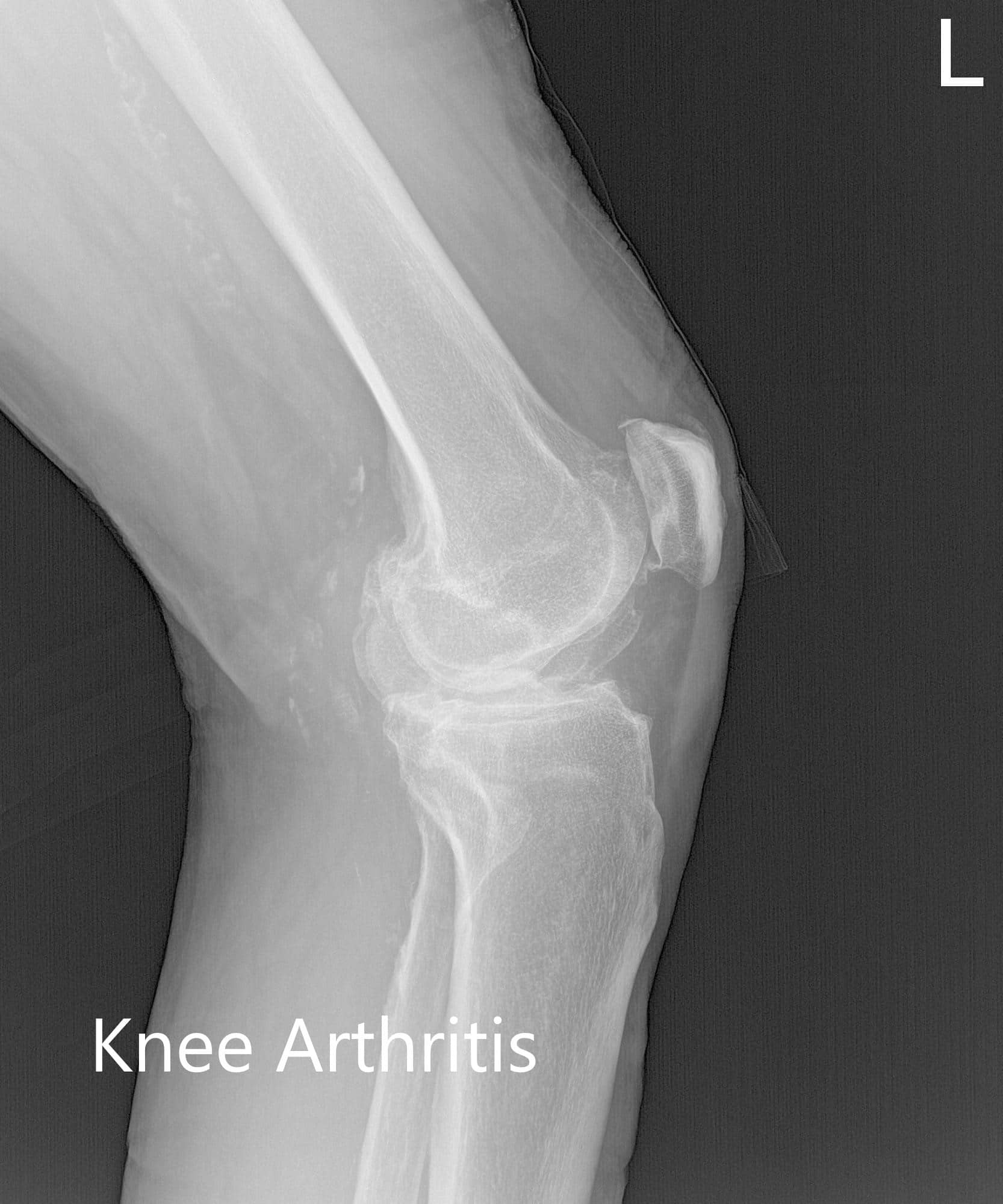 Radiografía preoperatoria de la rodilla izquierda que muestra las vistas AP, lateral y de la izquierda - img 2 Radiografía preoperatoria de la rodilla izquierda que muestra las vistas AP, lateral y de la izquierda - img 2