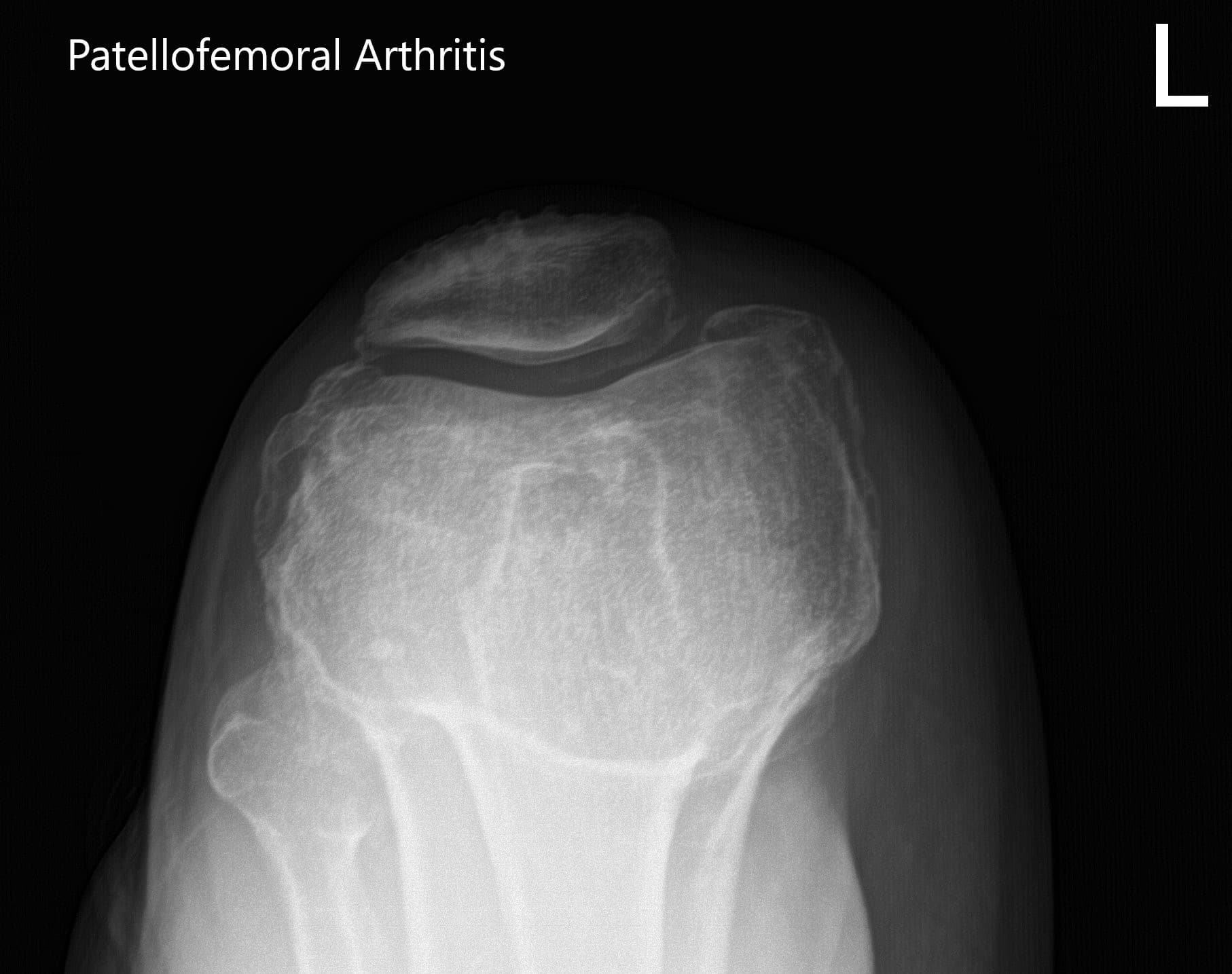 Radiografía preoperatoria de la rodilla izquierda que muestra las vistas AP, lateral y de la izquierda - IMG 3 Radiografía preoperatoria de la rodilla izquierda que muestra las vistas AP, lateral y de la izquierda - IMG 3