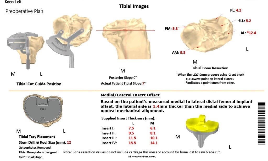 Plan quirúrgico completo específico para pacientes de Ortopedia para un reemplazo total personalizado de rodilla izquierda en una mujer de 68 años