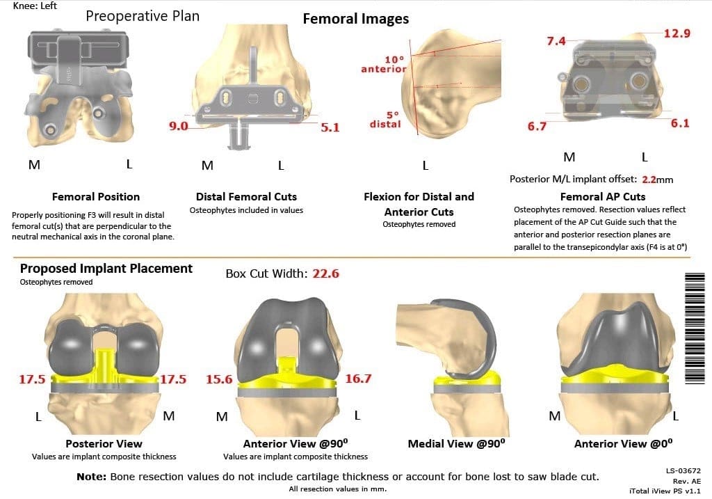 Plan quirúrgico completo específico para pacientes de Ortopedia para un reemplazo total personalizado de rodilla izquierda en una mujer de 68 años - ecografía 2