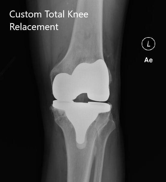 Radiografía postoperatoria de la rodilla izquierda que mostró visión AP y lateral Radiografía postoperatoria de la rodilla izquierda que mostró visión AP y lateral