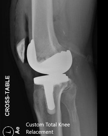Radiografía postoperatoria de la rodilla izquierda que muestra visión AP y lateral - img 2 Radiografía postoperatoria de la rodilla izquierda que muestra visión AP y lateral - img 2