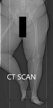 Imágenes topográficas de TC de la rodilla derecha e izquierda con soporte de peso respectivamente Imágenes topográficas de TC de la rodilla derecha e izquierda con soporte de peso respectivamente