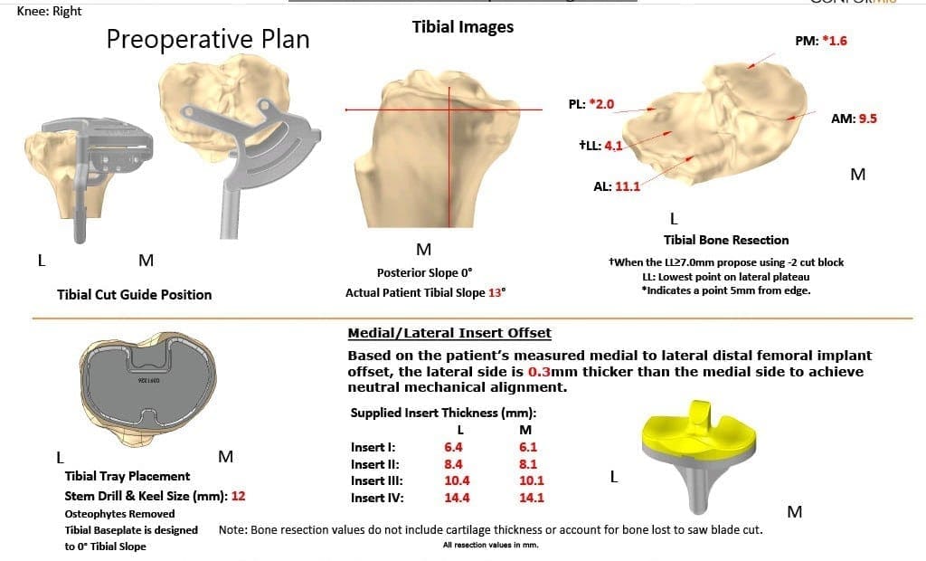 Plan quirúrgico completo de ortopedia específico para un reemplazo bilateral de rodilla personalizado en un hombre de 78 años