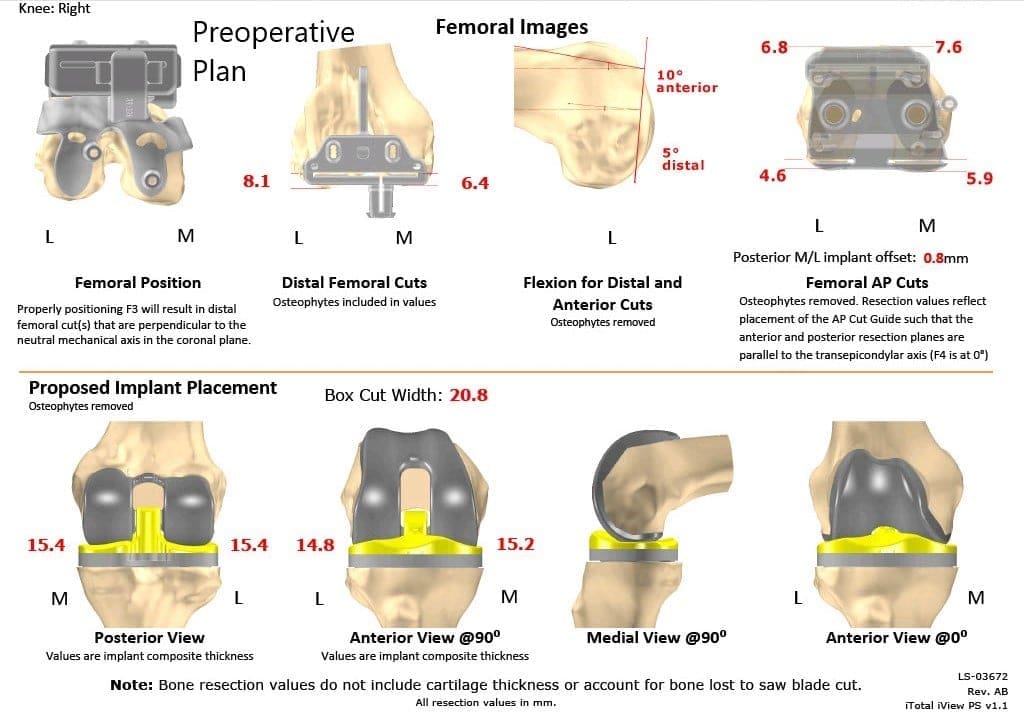 Plan quirúrgico completo de ortopedia específico para un reemplazo bilateral de rodilla personalizado en un hombre de 78 años - escáner 2