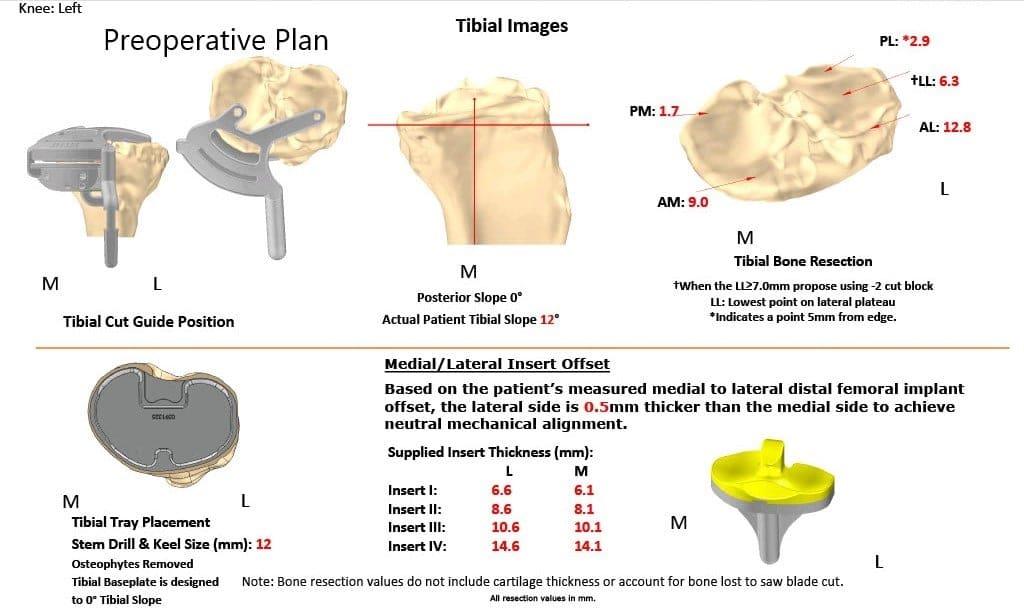 Plan quirúrgico completo específico para pacientes en ortopedia para un reemplazo bilateral personalizado de rodilla en un hombre de 78 años - ecografía 3