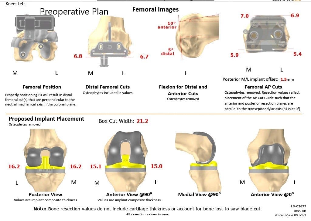 Plan quirúrgico completo específico para pacientes en ortopedia para un reemplazo bilateral personalizado de rodilla en un hombre de 78 años - ecografía 4