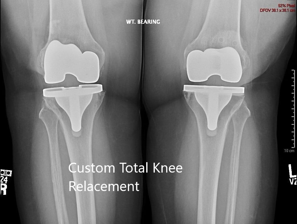 Radiografía postoperatoria que muestra la vista AP de ambas rodillas Radiografía postoperatoria que muestra la vista AP de ambas rodillas