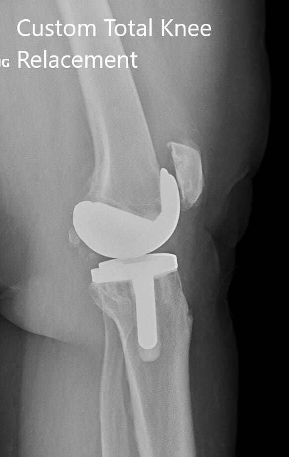 Radiografía postoperatoria que muestra las vistas laterales de ambas rodillas Radiografía postoperatoria que muestra las vistas laterales de ambas rodillas