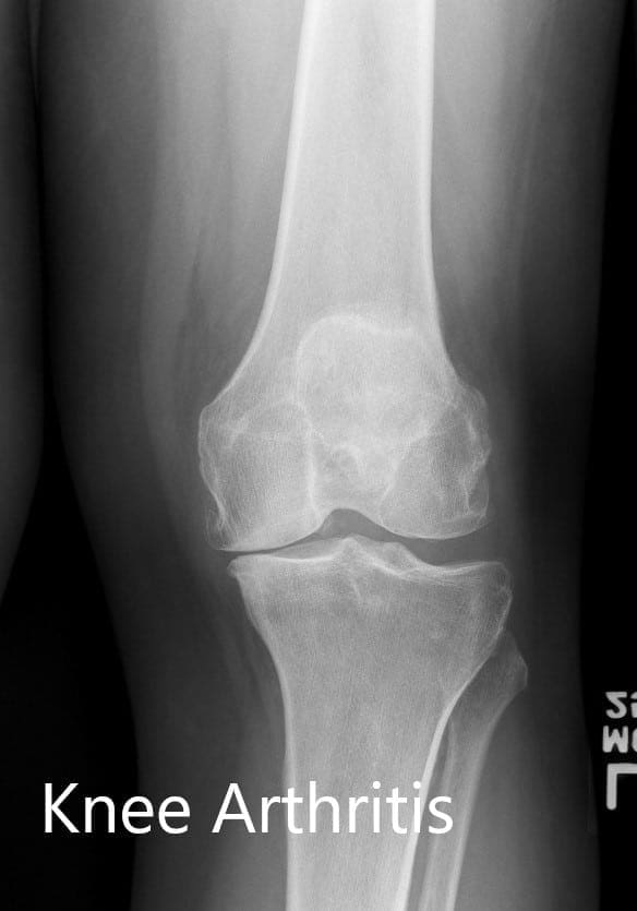 Radiografía preoperatoria de la rodilla izquierda que mostró vistas AP y laterales