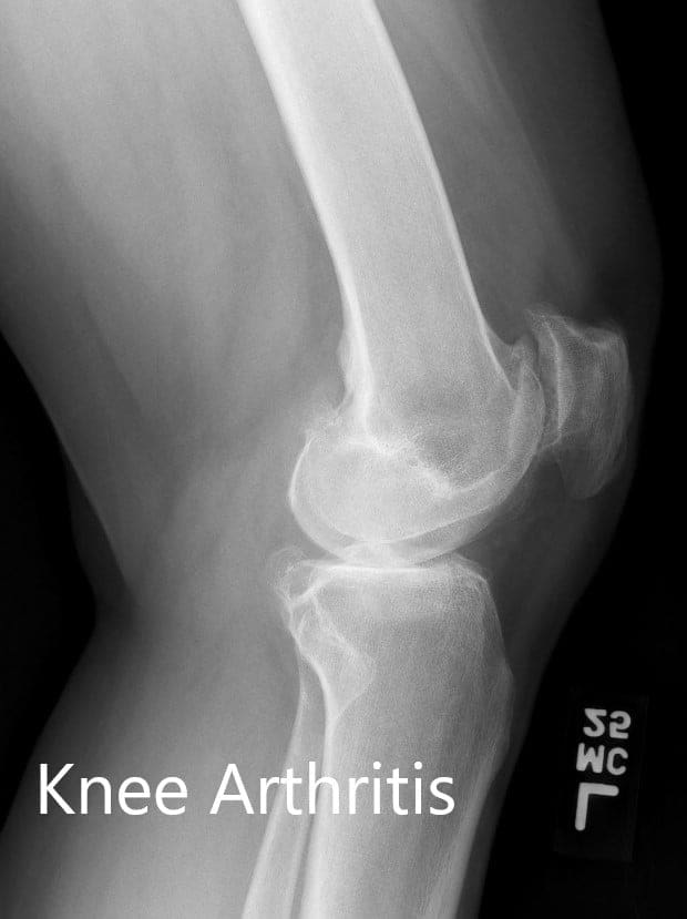 Radiografía preoperatoria de la rodilla izquierda que muestra visión AP y lateral - img 2
