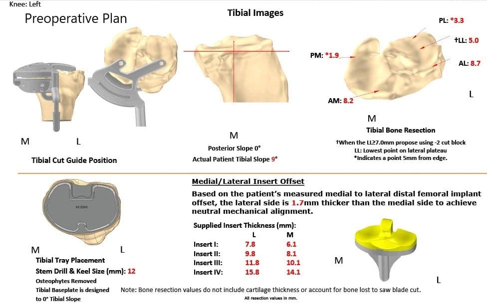 Plan quirúrgico completo específico para pacientes en ortopedia para un reemplazo total personalizado de rodilla izquierda en una mujer de 66 años