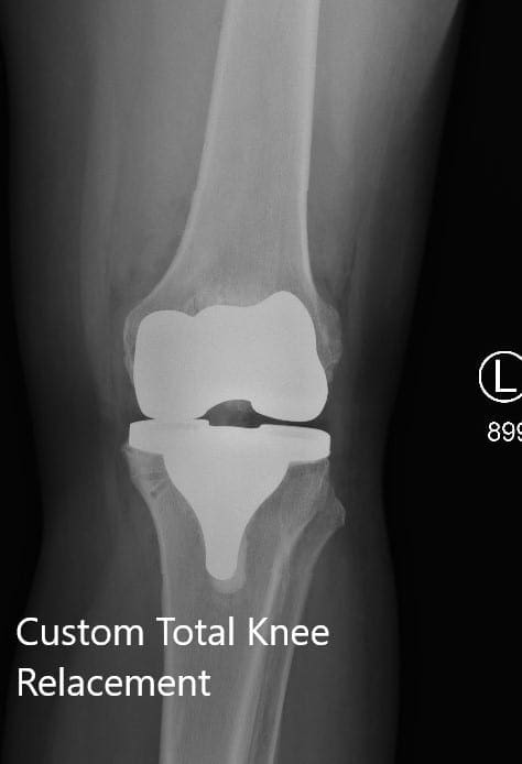 Radiografía postoperatoria que muestra la visión AP y lateral de la rodilla izquierda