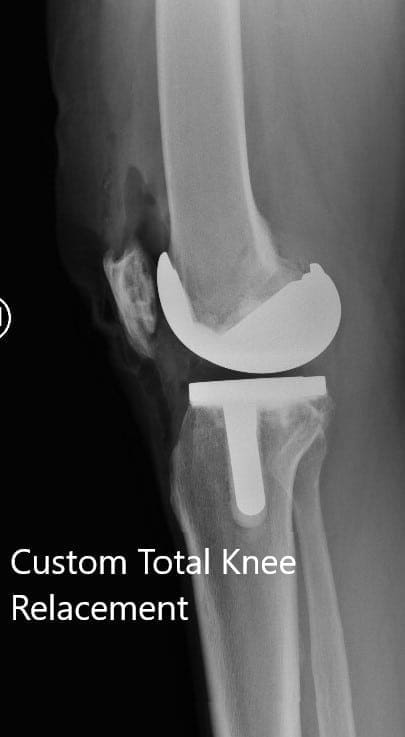 Radiografía postoperatoria que muestra la visión AP y lateral de la rodilla izquierda - IMG 2