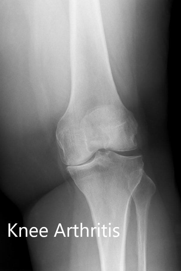 Radiografía preoperatoria que muestra la visión AP y lateral de la rodilla izquierda