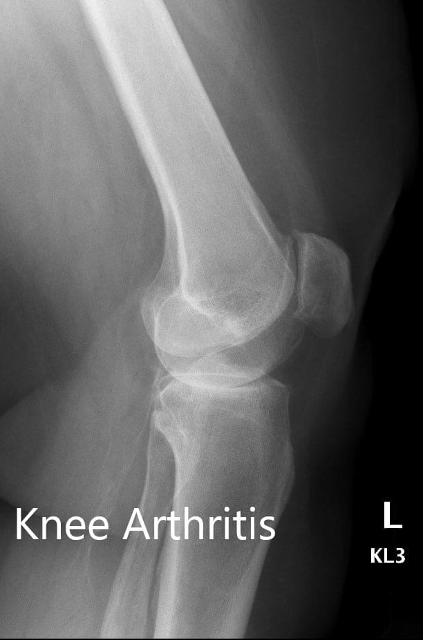 Radiografía preoperatoria que muestra la AP y las vistas laterales de la rodilla izquierda - img 2