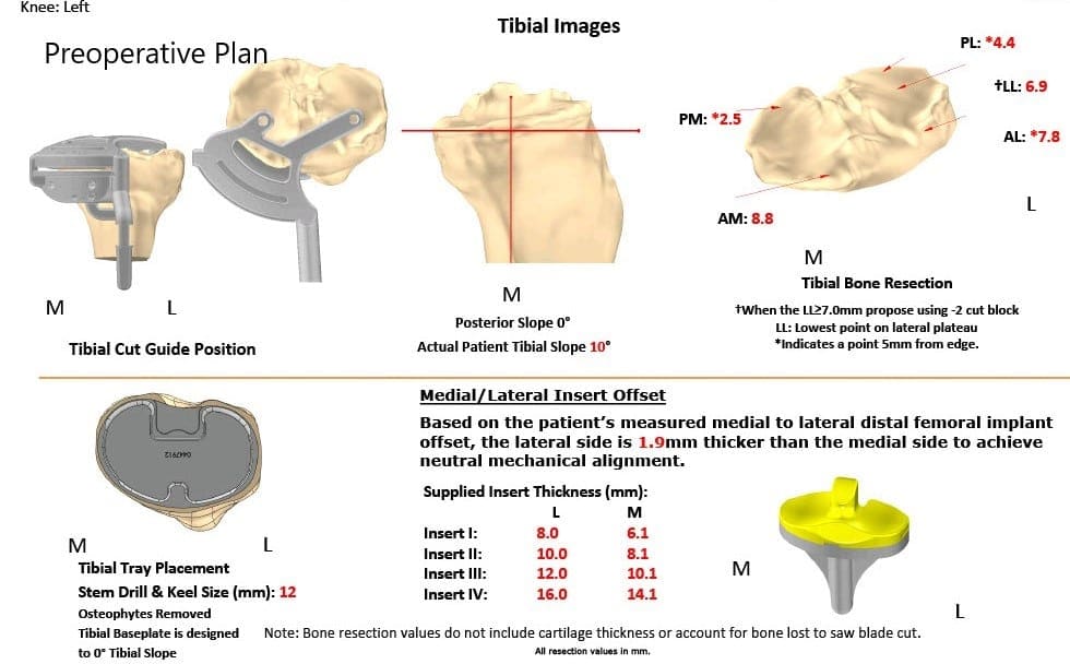 Plan quirúrgico completo específico para pacientes en ortopedia para un reemplazo total personalizado de rodilla izquierda en un hombre de 73 años