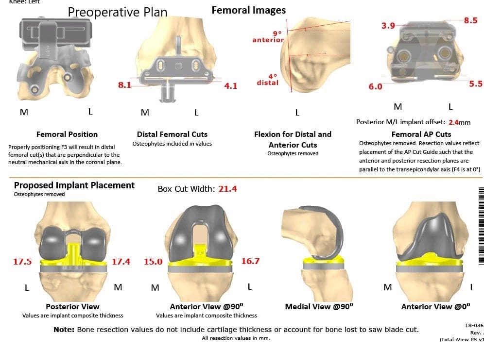 Plan quirúrgico completo específico para pacientes de Ortopedia para un reemplazo total personalizado de rodilla izquierda en un hombre de 73 años - escaneo 2