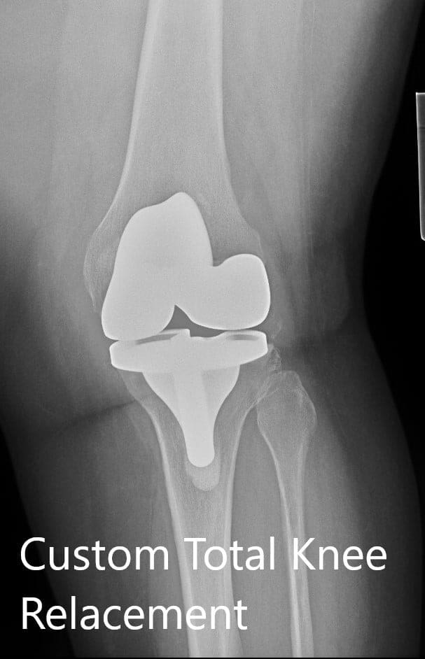 Radiografía postoperatoria que muestra la PA y la vista lateral de la rodilla izquierda